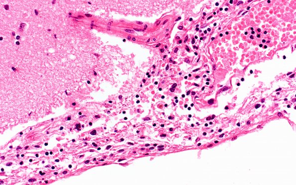 2B2 Lymphoma, secondary PTLD (Case 2) N3 40X