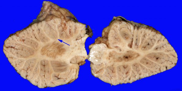 2C Lymphoma, secondary PTLD (Case 2) Gross 4 copy