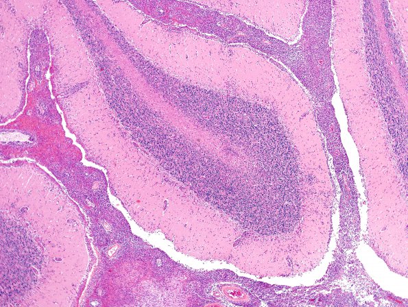 2D2 Lymphoma, secondary PTLD (Case 2) H&E 1