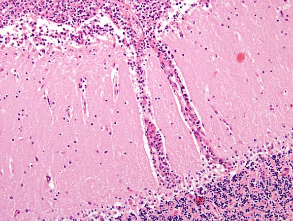 2D3 Lymphoma, secondary PTLD (Case 2) H&E 5