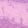 2D4 Lymphoma, secondary PTLD (Case 2) H&E 3