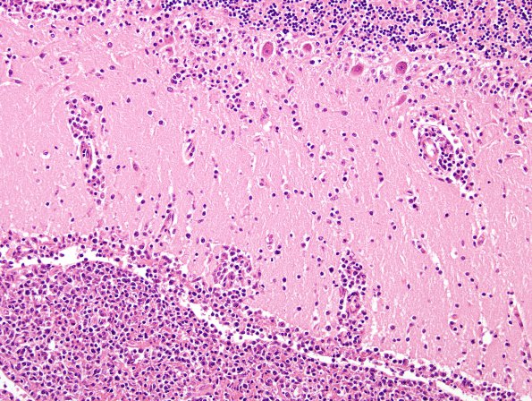 2D4 Lymphoma, secondary PTLD (Case 2) H&E 3