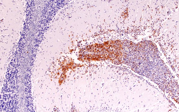 2E1 Lymphoma, secondary PTLD (Case 2) CD20 10X