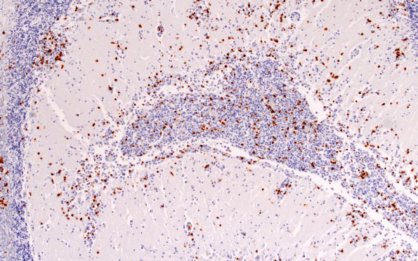 2F1 Lymphoma, secondary PTLD (Case 2) CD3 10X