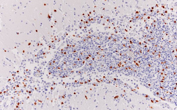 2F2 Lymphoma, secondary PTLD (Case 2) CD3 20X