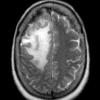 3A1 Lymphoma, Secondary DLBCL to Dura (Case 3) MRI 4 - Copy - Copy