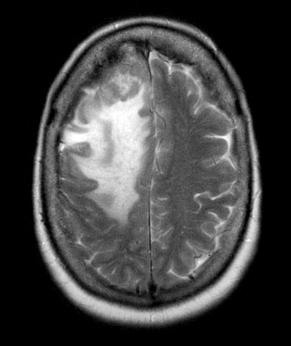 3A1 Lymphoma, Secondary DLBCL to Dura (Case 3) MRI 4 - Copy - Copy