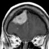 3A2 Lymphoma, Secondary DLBCL to Dura (Case 3) MRI 5 - Copy - Copy