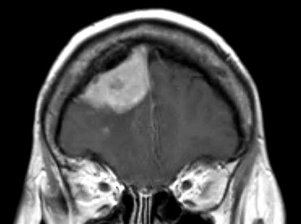 3A2 Lymphoma, Secondary DLBCL to Dura (Case 3) MRI 5 - Copy - Copy