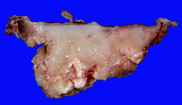 3B Lymphoma, Secondary DLBCL to Dura (Case 3) Gross_2