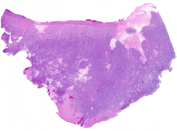 3C1 Lymphoma, Secondary DLBCL to Dura (Case 3) 1 H&E WM 1