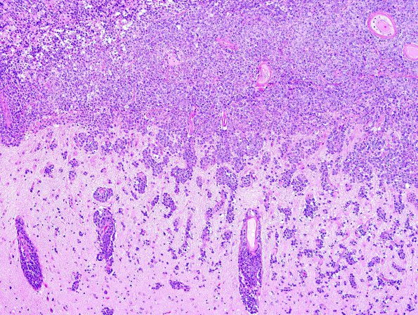 3C2 Lymphoma, Secondary DLBCL to Dura (Case 3) 2.jpg