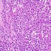 3C3 Lymphoma, Secondary DLBCL to Dura (Case 3) 4.jpg