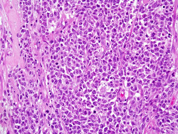 3C3 Lymphoma, Secondary DLBCL to Dura (Case 3) 4.jpg