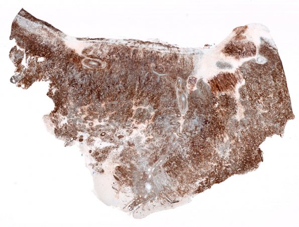 3D2 Lymphoma, Secondary DLBCL to Dura (Case 3) 1 CD79a WM