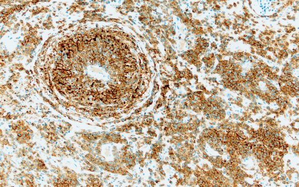 3D3 Lymphoma, Secondary DLBCL to Dura (Case 3) CD79a 20X