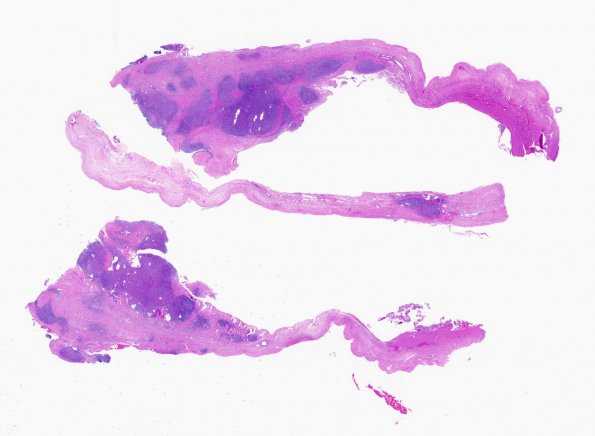 4B1 Lymphoma, Hodgkin's (Case 4) H&E WM