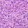 4B2 Lymphoma, Hodgkin's (Case 4) H&E 3.jpg