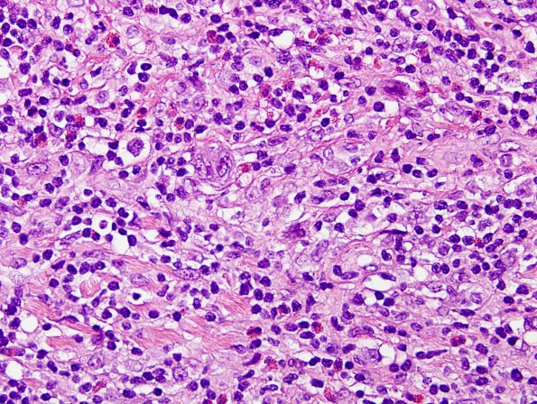 4B2 Lymphoma, Hodgkin's (Case 4) H&E 3.jpg