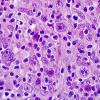 4B3 Lymphoma, Hodgkin's (Case 4) H&E 5.jpg