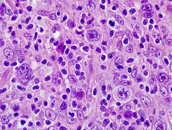 4B3 Lymphoma, Hodgkin's (Case 4) H&E 5.jpg