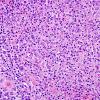 4B4 Lymphoma, Hodgkin's (Case 4) H&E 7.jpg