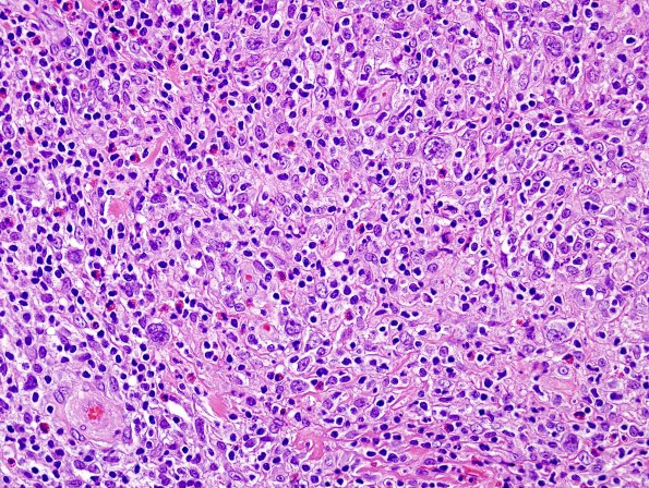 4B4 Lymphoma, Hodgkin's (Case 4) H&E 7.jpg