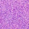 4B5 Lymphoma, Hodgkin's (Case 4) H&E 8.jpg