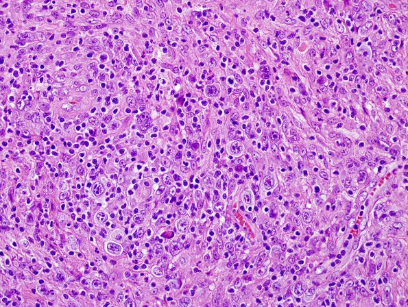 4B5 Lymphoma, Hodgkin's (Case 4) H&E 8.jpg