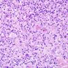 4B6 Lymphoma, Hodgkin's (Case 4) H&E 13.jpg