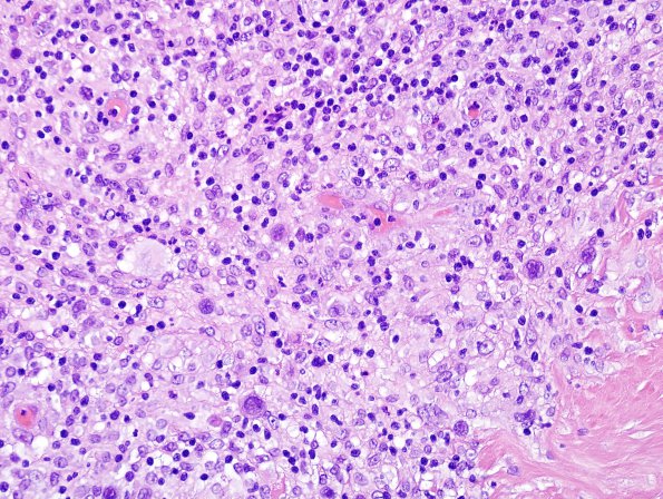 4B6 Lymphoma, Hodgkin's (Case 4) H&E 13.jpg