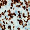 4C1 Lymphoma, Hodgkin's (Case 4) CD3 1.jpg