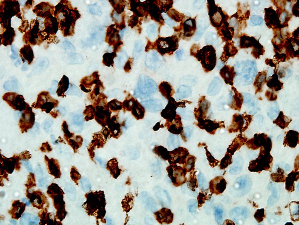 4C1 Lymphoma, Hodgkin's (Case 4) CD3 1.jpg