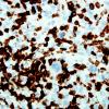 4C2 Lymphoma, Hodgkin's (Case 4) CD3 7.jpg