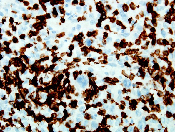 4C2 Lymphoma, Hodgkin's (Case 4) CD3 7.jpg