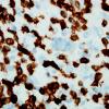 4C3 Lymphoma, Hodgkin's (Case 4) CD3 2.jpg