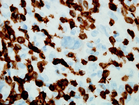 4C3 Lymphoma, Hodgkin's (Case 4) CD3 2.jpg