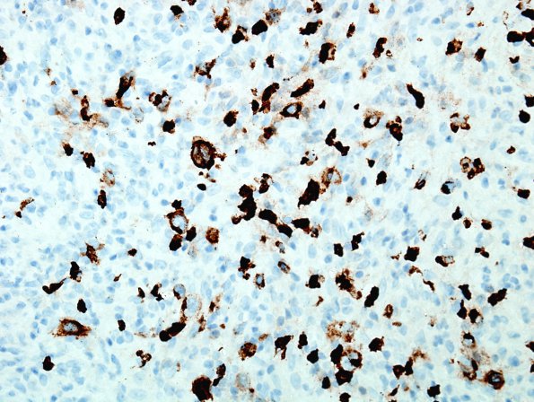 4D Lymphoma, Hodgkin's (Case 4) CD15 2.jpg