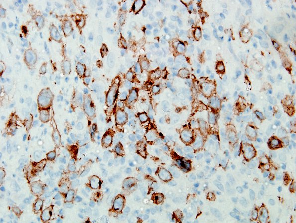 4E2 Lymphoma, Hodgkin's (Case 4) CD30 6.jpg