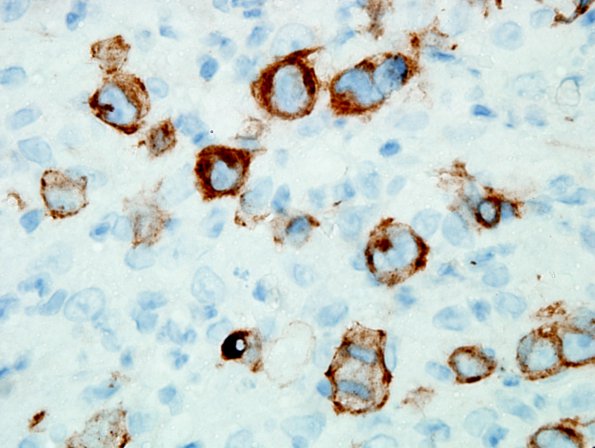 4E3 Lymphoma, Hodgkin's (Case 4) CD30 1.jpg