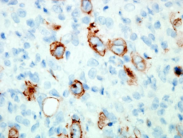 4E4Lymphoma, Hodgkin's (Case 4) CD30 3.jpg