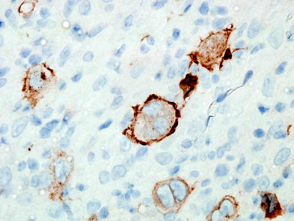 4E5 Lymphoma, Hodgkin's (Case 4) CD30 4.jpg