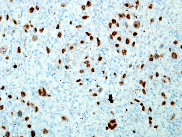 4F1 Lymphoma, Hodgkin's (Case 4) PAX-5 4.jpg