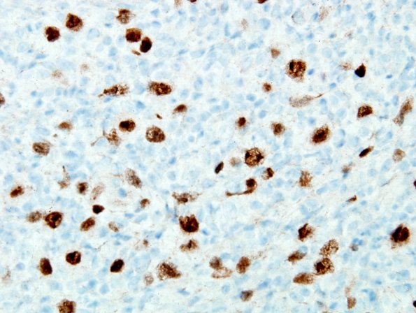 4F2 Lymphoma, Hodgkin's (Case 4) PAX-5 6.jpg