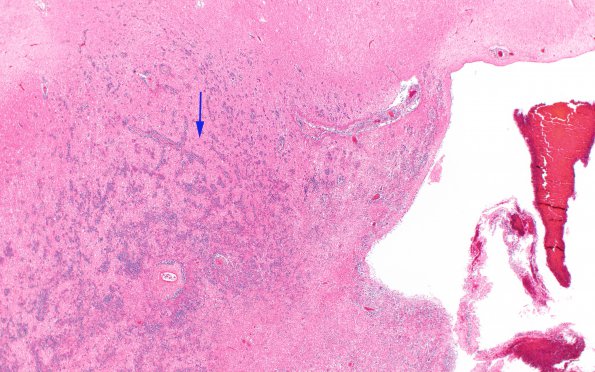 5B1 Lymphoma, secondary (Case 5) N17 2X copy