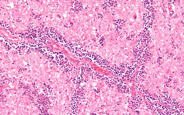 5B2 Lymphoma, secondary (Case 5) N17 20X