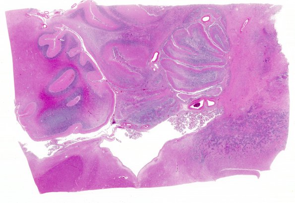 5C1 Lymphoma, secondary (Case 5) N21 H&E whole mount