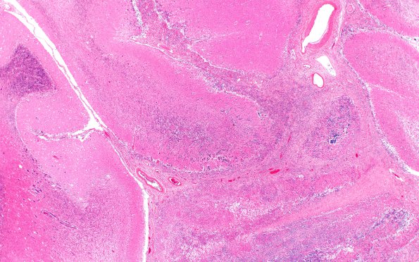 5C2 Lymphoma, secondary (Case 5) N20 2X