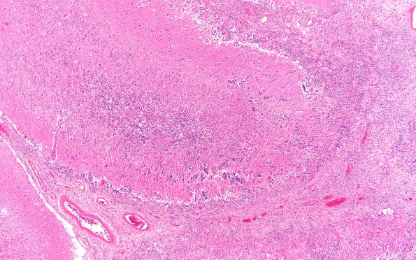 5C3 Lymphoma, secondary (Case 5) N20 4X