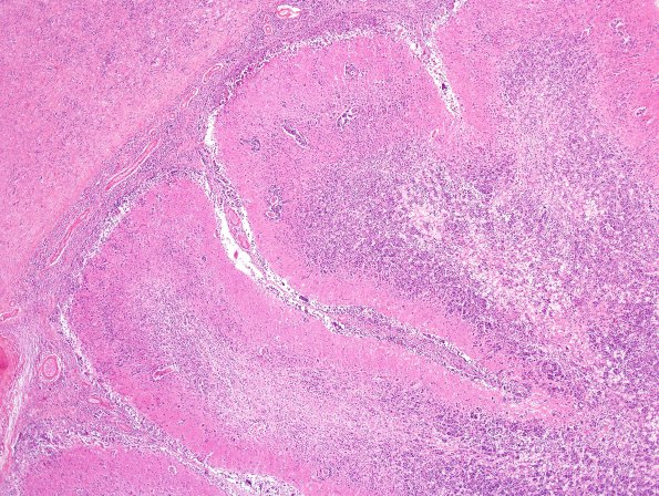 5C4 Lymphoma, secondary (Case 5) H&E 2.jpg